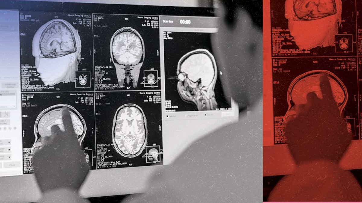 Estudo monitora a ação da anestesia no cérebro