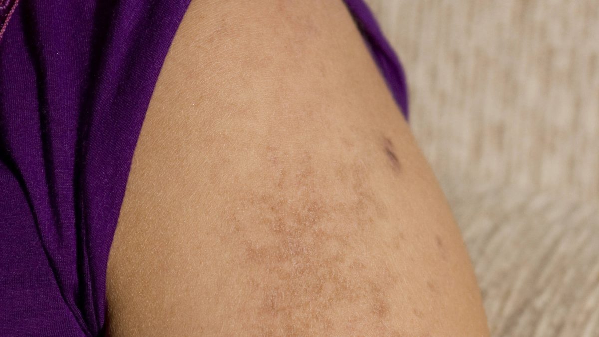 Butantan firma acordo para desenvolver terapia CAR-T contra lúpus e miastenia gravis