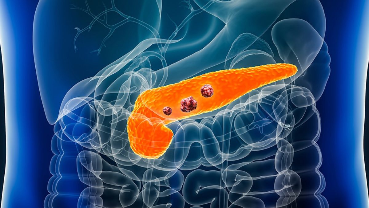 Nova pílula dobra sobrevida de pacientes com câncer de pâncreas metastático